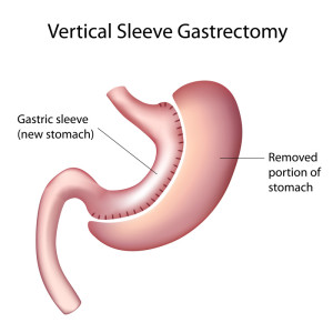 Gastrectomy-Melbourne